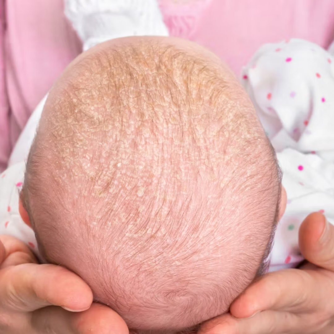 Understanding and Managing Newborn Dry Scalp