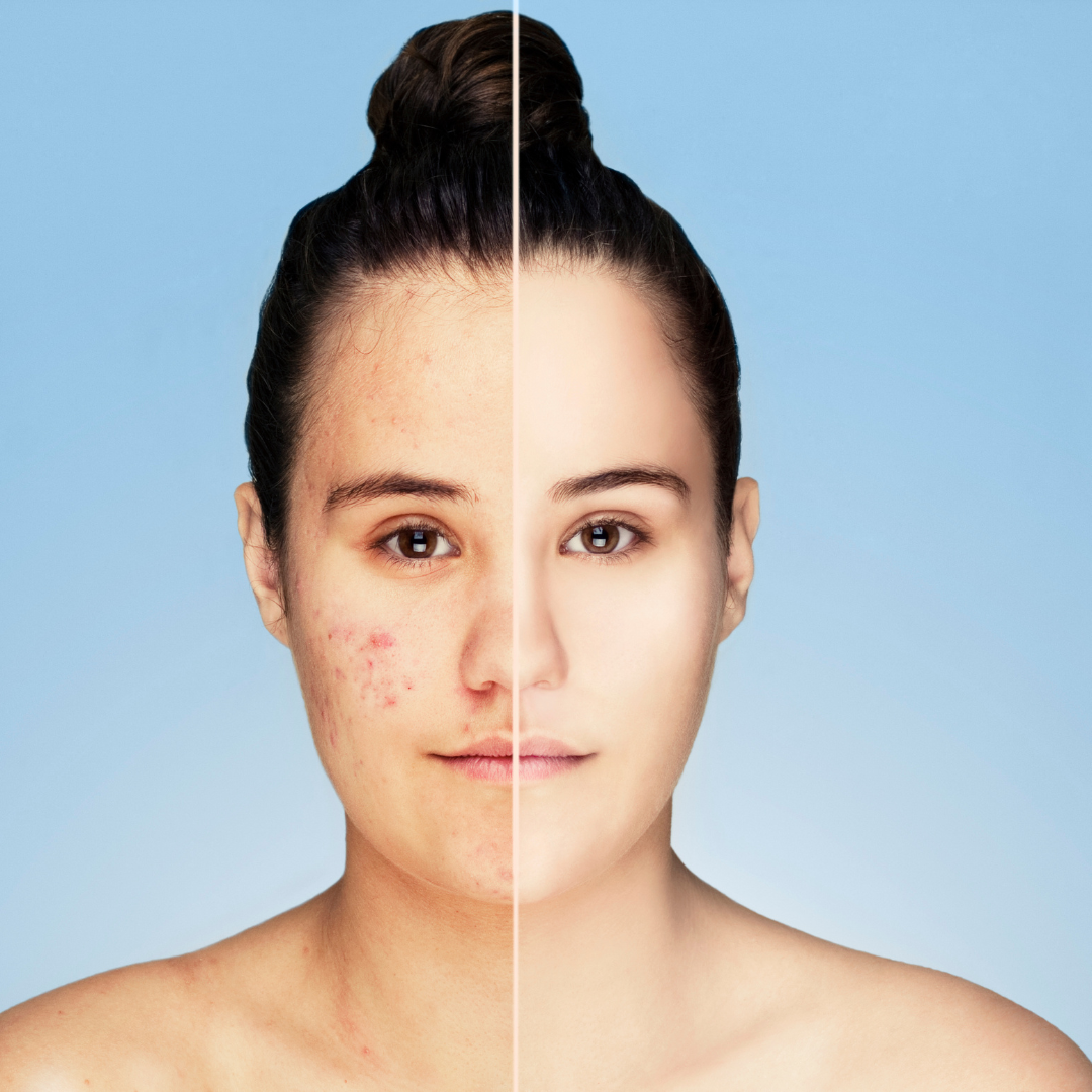 How to Treat Acne Naturally?